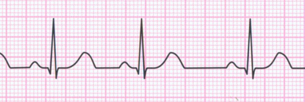 ekg, badanie ekg, interpretacja ekg, odczytywanie ekg